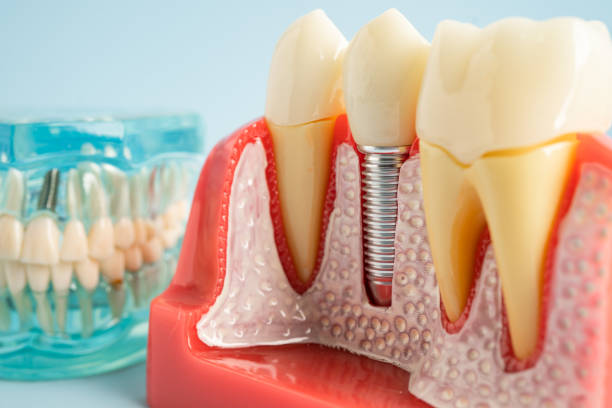 Best Dental Inlays and Onlays  in Cutchogue, NY